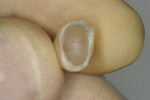 Figure 7  The patient’s natural tooth was hallowed out in order to be used as a provisional restoration.