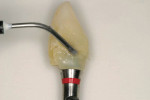 Figure 9  The natural tooth was relined out of the mouth to fit the solid abutment.