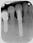 Figure 14  This tooth has been on the abutment temporarily cemented for more than 6 years.