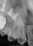 Preoperative radiograph showing the plates and screws from the patient’s previous surgeries. The amount of decay can also be visualized.