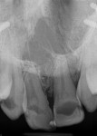 Preoperative radiograph showing the plates and screws from the patient’s previous surgeries. The amount of decay can also be visualized.