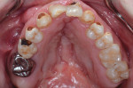 Preoperative occlusal view of the maxillary arch.