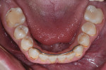 Preoperative occlusal view of the mandibular arch.
