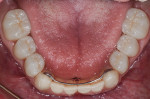 Postoperative occlusal view of final lower zirconia crowns.