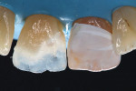 Lingual shelf created with the putty matrix, ensuring minimal thickness to prevent color distortion of the dentin layer.