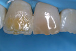 Application of dentin shade and tints for characterization.