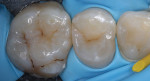 Clinical and radiographic examination revealed caries of the cuspid and bicuspid.
