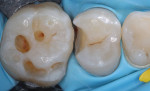 Caries removal with minimally invasive preparation protocols under microscope.
