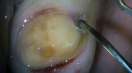 Scrub and overfill the sulcus with 25% aluminum chloride hemostatic gel.