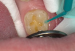 View of prepared tooth No. 31 following decay removal from carious occlusal and buccal grooves.