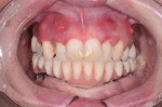 Fig 1. Initial clinical presentation with terminal maxillary dentition.