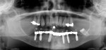 Fig 2. Initial radiographic assessment showing nonrestorable condition of the maxillary arch.