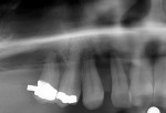 Fig 3. Radiographs showing presence of bone in the bicuspid areas (zone 2) of the posterior maxillary arch and lack of bone in the molar areas (zone 3); upper right quadrant.