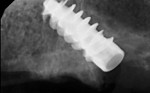 Fig 6. The implant placed in position of tooth No. 14.