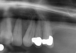 Fig 4. Radiographs showing presence of bone in the bicuspid areas (zone 2) of the posterior maxillary arch and lack of bone in the molar areas (zone 3); upper left quadrant.