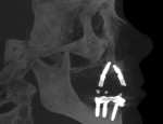 Fig 10. CBCT imaging of the final position of the implants; right lateral view.