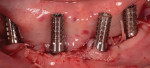 Fig 13. Temporary abutments used for the direct conversion of the provisional fixed prosthesis.