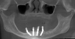 Fig 15. CBCT imaging of the final position of the implants.