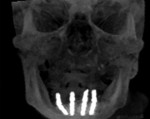 Fig 16. CBCT imaging of the final position of the implants.