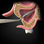 Fig 9. Diagrams showing lateral window approach to the maxillary sinus to retrieve displaced implant. Implant is displaced in maxillary sinus (Fig 8). Lateral window allows good access and visibility to maxillary sinus and displaced implant (Fig 9). Implant is retrieved from maxillary sinus through lateral window (Fig 10).