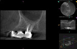 Fig 4. Case 1. The 6-month follow-up CBCT sagittal view showed reduced thickness of the maxillary sinus mucous membrane and periapical healing of the lesion of endodontic origin.