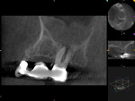 Fig 2. Case 1. Preoperative CBCT sagittal view of the buccal roots showed thickening of the mucous membrane of the maxillary sinus apical to tooth No. 14.