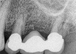 Fig 1. Case 1. Preoperative periapical radiograph showed PFM bridge extending from No. 12 to No. 14.