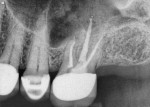Fig 7. Case 2. The 12-month follow-up periapical radiograph showed completed endodontic retreatment of tooth No. 14, including the extraction site of No. 15.