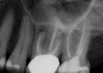 Fig 9. Case 3. Preoperative periapical radiograph showed previous root canal treatment on teeth Nos. 14 and 15.