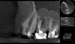 Fig 10. Case 3. Preoperative CBCT sagittal view showed the extent of the dome-shaped radiopacities apical to teeth Nos. 14 and 15.