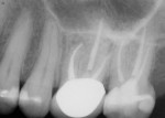 Fig 11. Case 3. Periapical radiograph showed completed retreatment and 1-year recall of tooth No. 14.