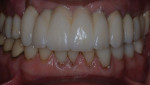 Fig 2. The 64-year-old patient is unhappy with his dental esthetics, especially the bright white teeth, as he feels they are no longer age-appropriate.