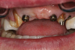 Fig 5. Removal of the implant-fixed dental prosthesis and crowns shows the patient’s implants and remaining dentition.