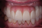 Fig 9. The patient wore the final provisionals for 2 months before providing approval.