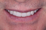 Fig 13. The final restorations meet all of the patient’s requirements for esthetics and function.
