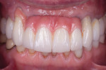 Fig 14. The final restorations meet all of the patient’s requirements for esthetics and function.