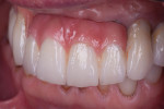 Fig 15. The final restorations meet all of the patient’s requirements for esthetics and function.