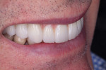 Fig 16. The final restorations meet all of the patient’s requirements for esthetics and function.