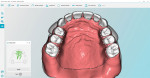 Fig 8. The software transposes the patient’s rugae from the impression onto the denture palate for milling.