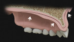 Fig 1. Occlusal loading causes the maxillary denture to seat and flabby anterior ridge tissue to conform to the intaglio of the denture.