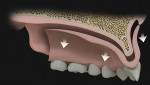 Fig 2. When the teeth are apart, flabby tissue rebounds and dislodges the denture.
