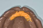 Fig 5. A minimally displacive impression of anterior maxillary flabby tissue is captured with orange PVS material inside the window of a custom tray.