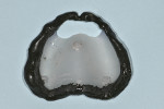 Fig 4. The border-molded tray records a functional sulcus.
