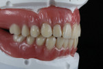 The precise level of reproducibility that becomes available when a denture is digitally designed is something that conventional processes simply cannot offer. (Photo courtesy of Alexander Wünsche, CDT.)