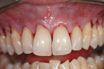 Figure 2  Intrasulcular incisions have been made buccal to teeth Nos. 5 through 12. Care was taken not to traumatize the interdental papillae.