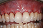 Figure 4  The acellular dermal matrix was placed within the tunnel. The blood-stained matrix can be seen below the gingival margin.
