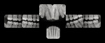Fig 2. Patient’s full-mouth x-rays, pretreatment.