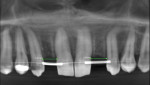 Fig 4. Post-orthodontic CBCT scan, with 6.2 mm of space at No. 7 and 6.8 mm at No. 10. Note the change in the direction of the apices of the central incisors and canines.