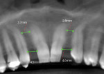 Fig 3. Pre-orthodontic CBCT scan showed the roots of the central incisors and canines converged toward each other. The space at No. 7 was 4.5 mm; No. 10 had a space of 4.6 mm.