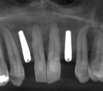Fig 6. CBCT scan with implants placed.